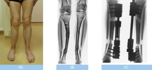 cable bone transport