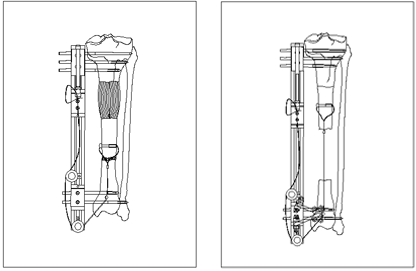 Cable bone transport